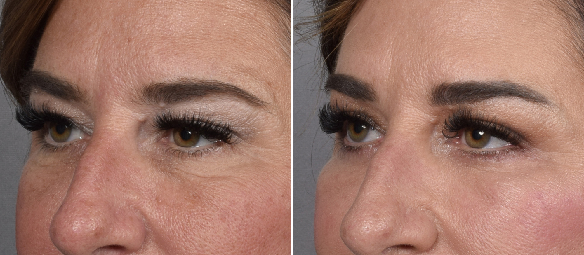 Upper Blepharoplasty Before & After Gallery - Patient 204321 - Image 1