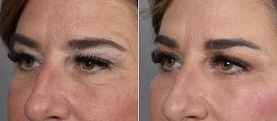 Upper Blepharoplasty Before & After Gallery - Patient 204321 - Image 1