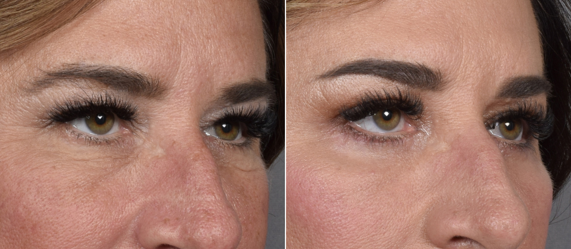 Upper Blepharoplasty Before & After Gallery - Patient 204321 - Image 2