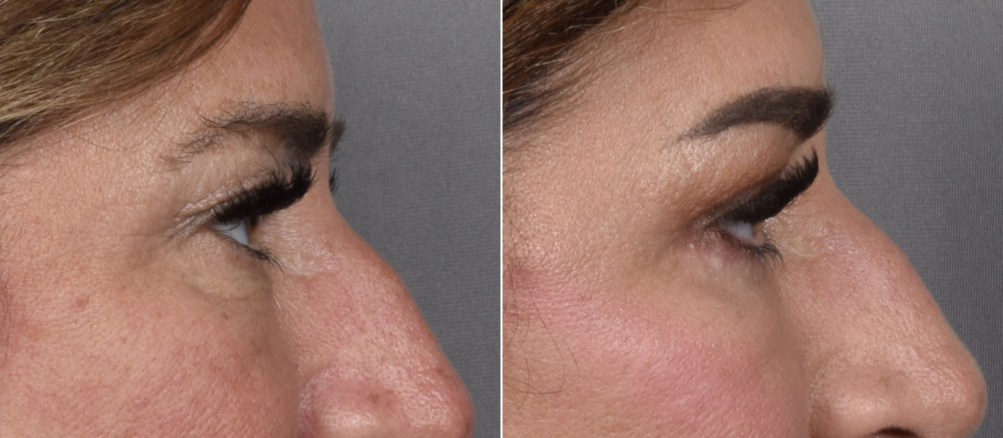 Upper Blepharoplasty Before & After Gallery - Patient 204321 - Image 3