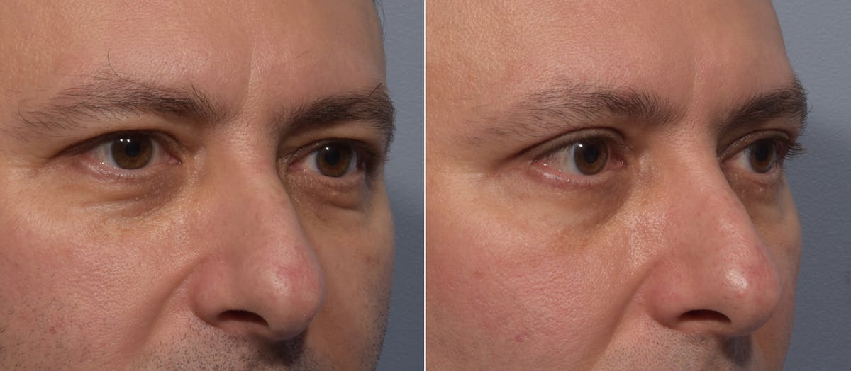 Upper Blepharoplasty Before & After Gallery - Patient 144747 - Image 3