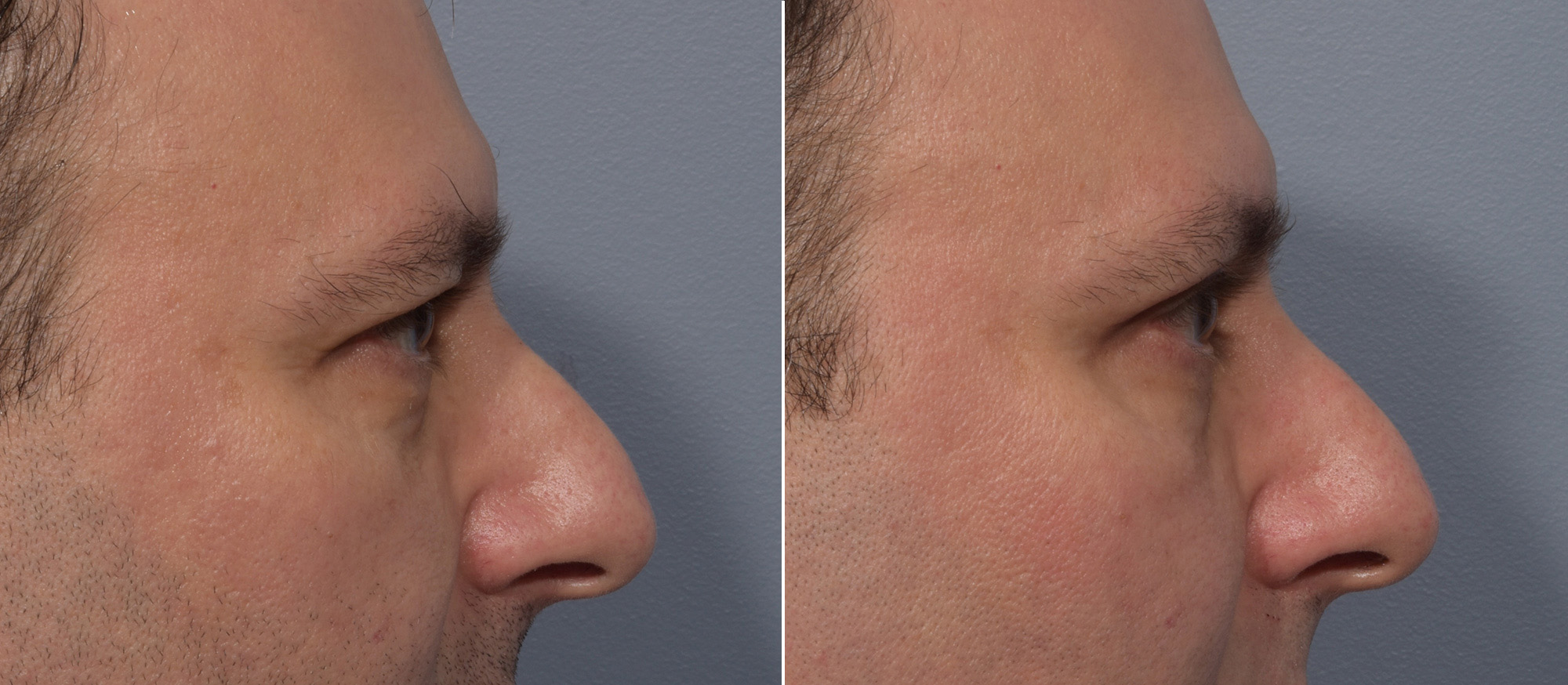 Upper Blepharoplasty Before & After Gallery - Patient 144747 - Image 4