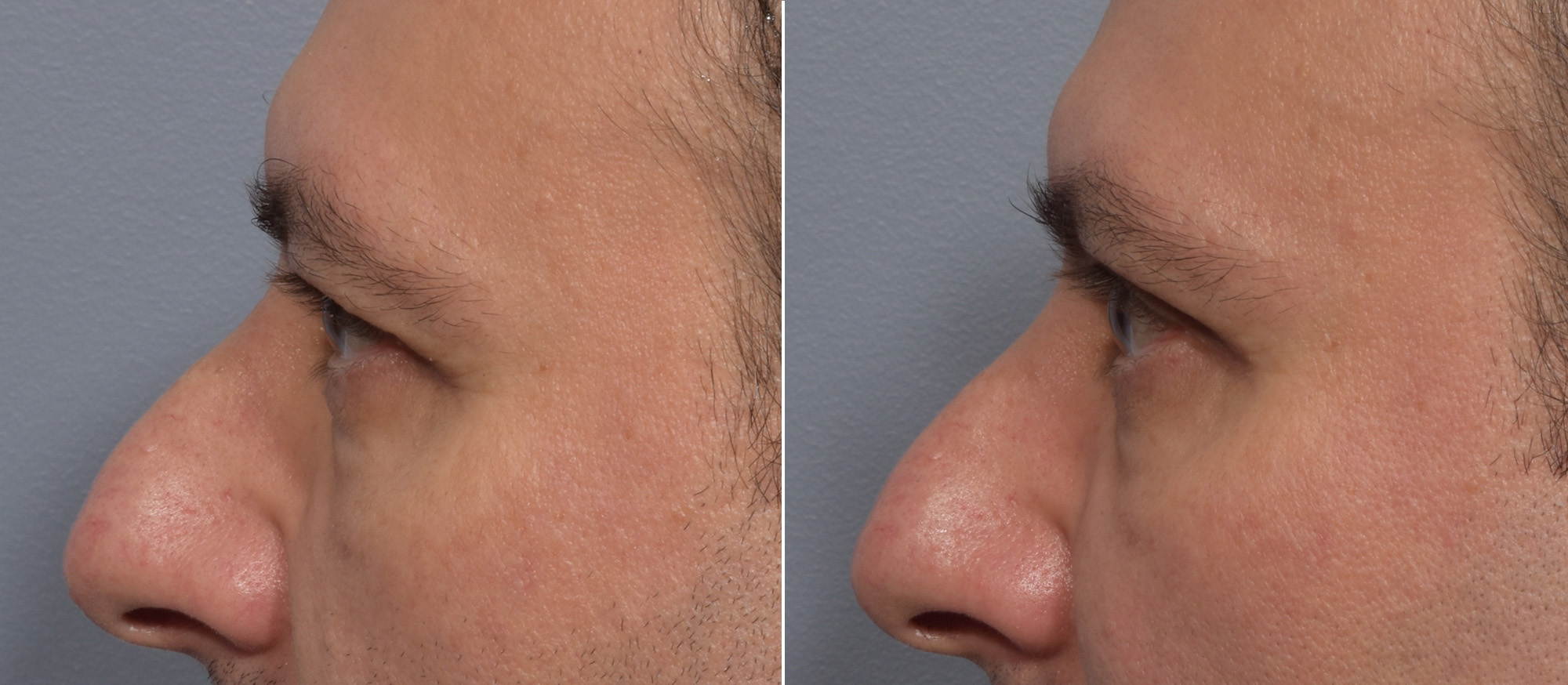 Upper Blepharoplasty Before & After Gallery - Patient 144747 - Image 5