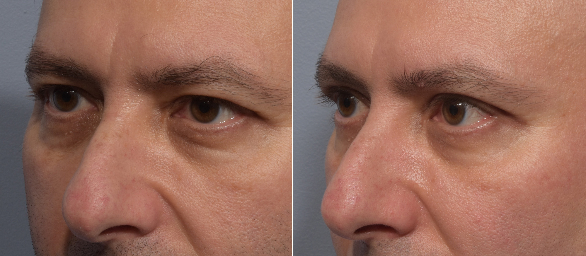 Upper Blepharoplasty Before & After Gallery - Patient 144747 - Image 1