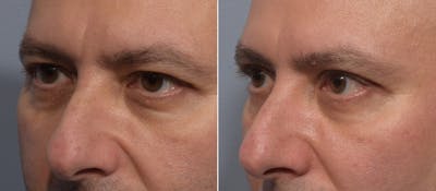 Upper Blepharoplasty Before & After Gallery - Patient 144747 - Image 1