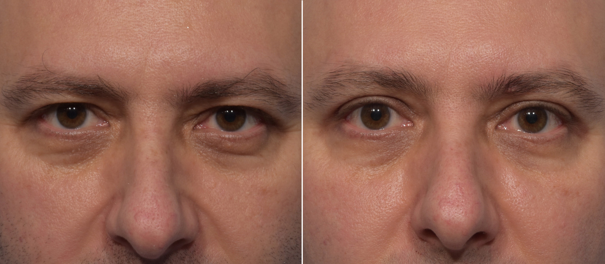 Upper Blepharoplasty Before & After Gallery - Patient 144747 - Image 2
