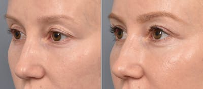 Upper Blepharoplasty Before & After Gallery - Patient 128844 - Image 1