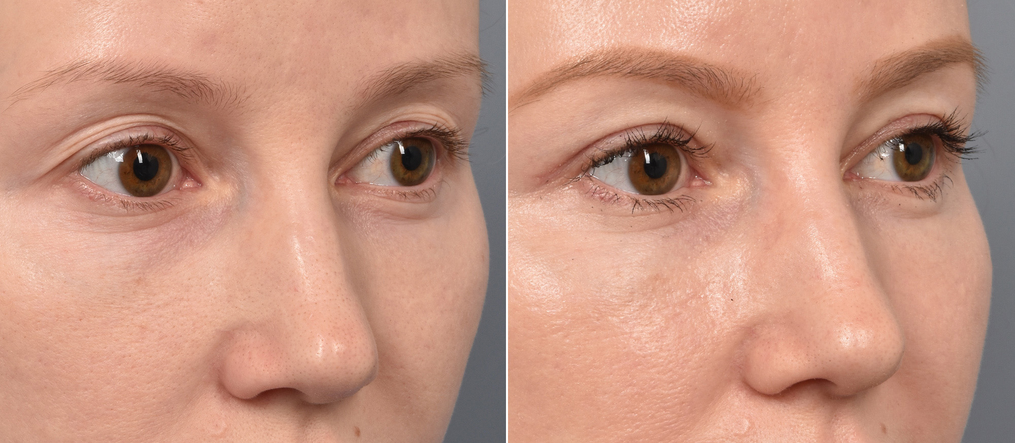 Upper Blepharoplasty Before & After Gallery - Patient 128844 - Image 2