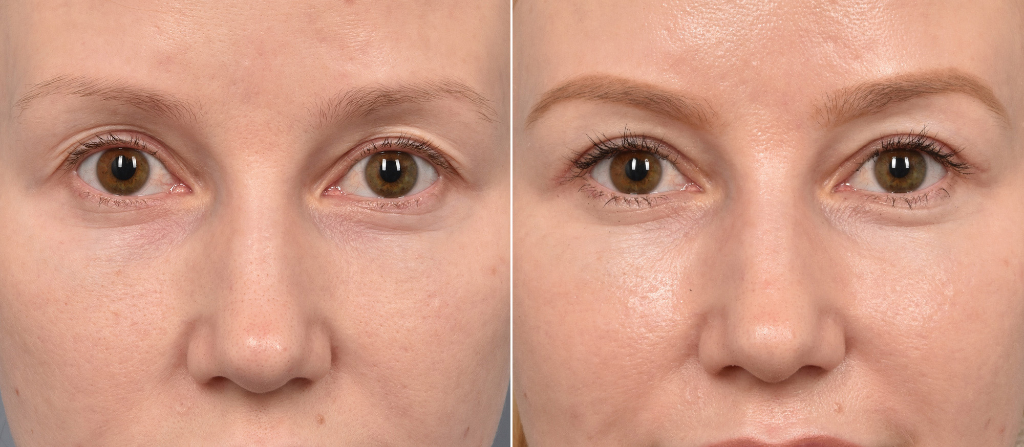 Upper Blepharoplasty Before & After Gallery - Patient 128844 - Image 3