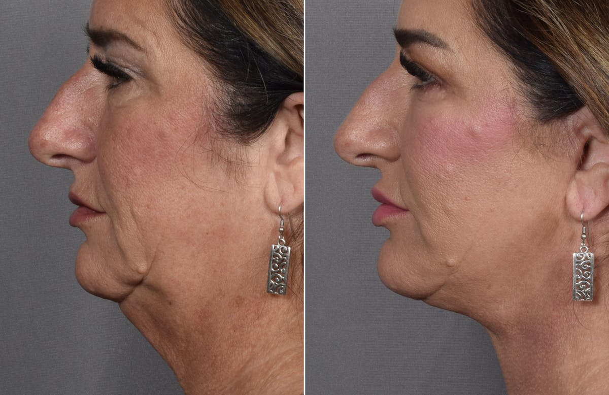 Facelift Before & After Gallery - Patient 127018 - Image 3