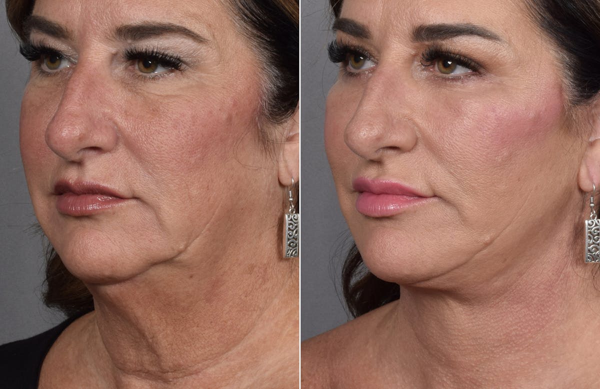 Facelift Before & After Gallery - Patient 127018 - Image 4