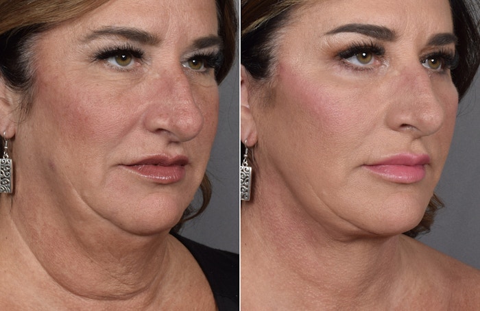 Facelift Before & After Gallery - Patient 127018 - Image 1