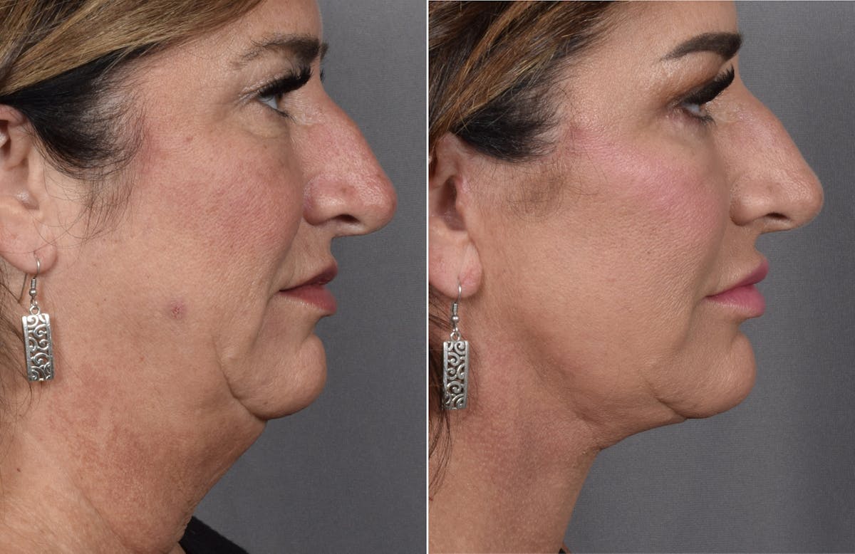 Facelift Before & After Gallery - Patient 127018 - Image 2
