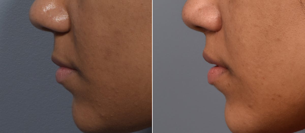 Lip Lift Before & After Gallery - Patient 255491 - Image 5