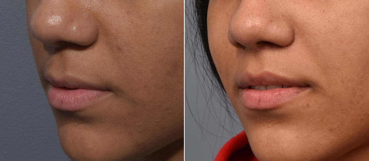 Lip Lift Before & After Gallery - Patient 255491 - Image 2