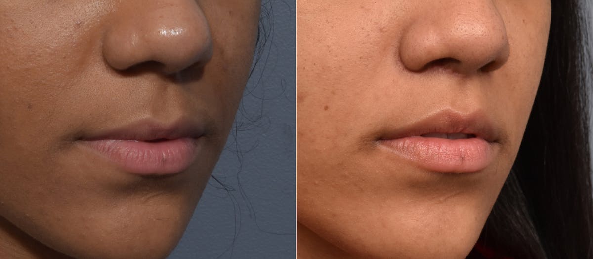 Lip Lift Before & After Gallery - Patient 255491 - Image 3
