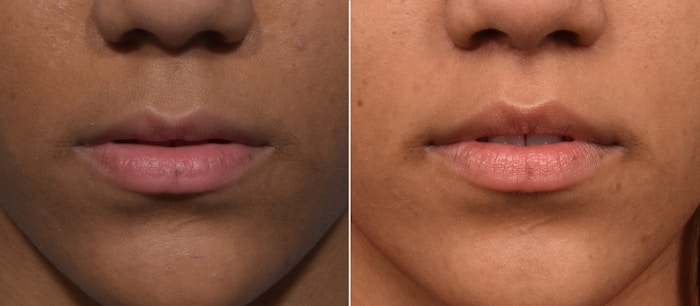 Lip Lift Before & After Gallery - Patient 255491 - Image 1
