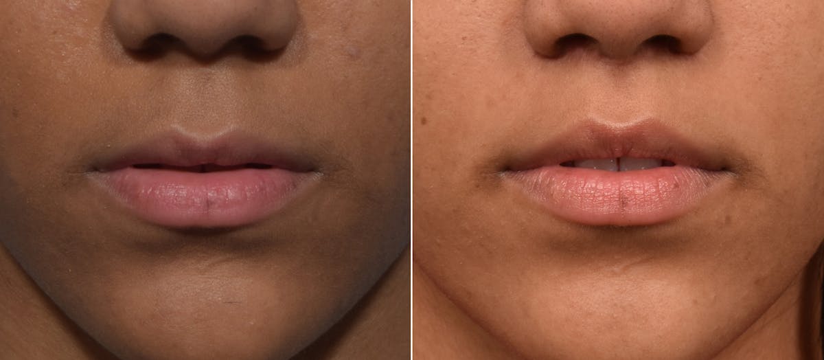 Lip Lift Before & After Gallery - Patient 255491 - Image 1