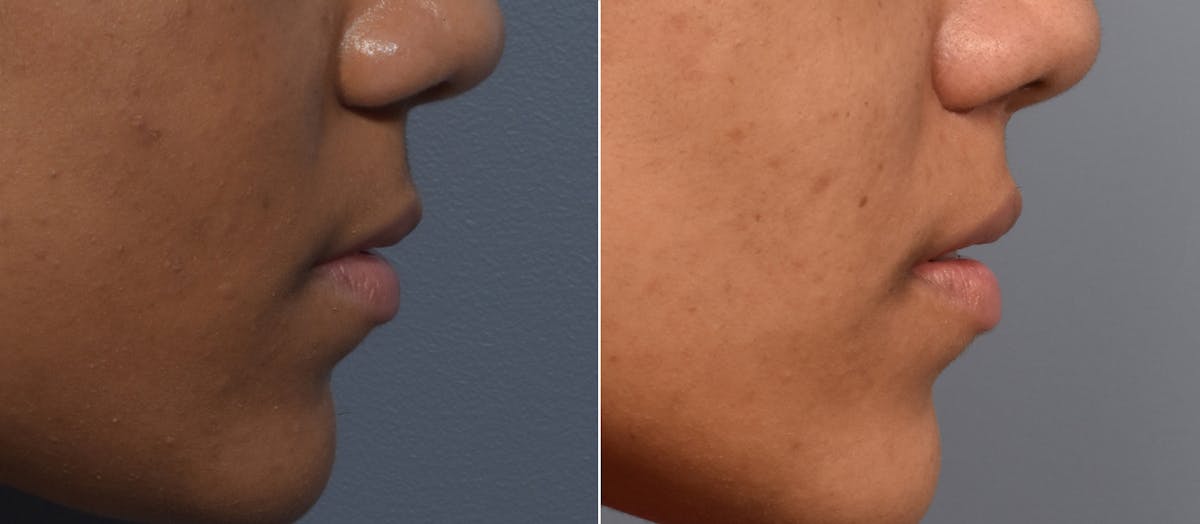 Lip Lift Before & After Gallery - Patient 255491 - Image 4