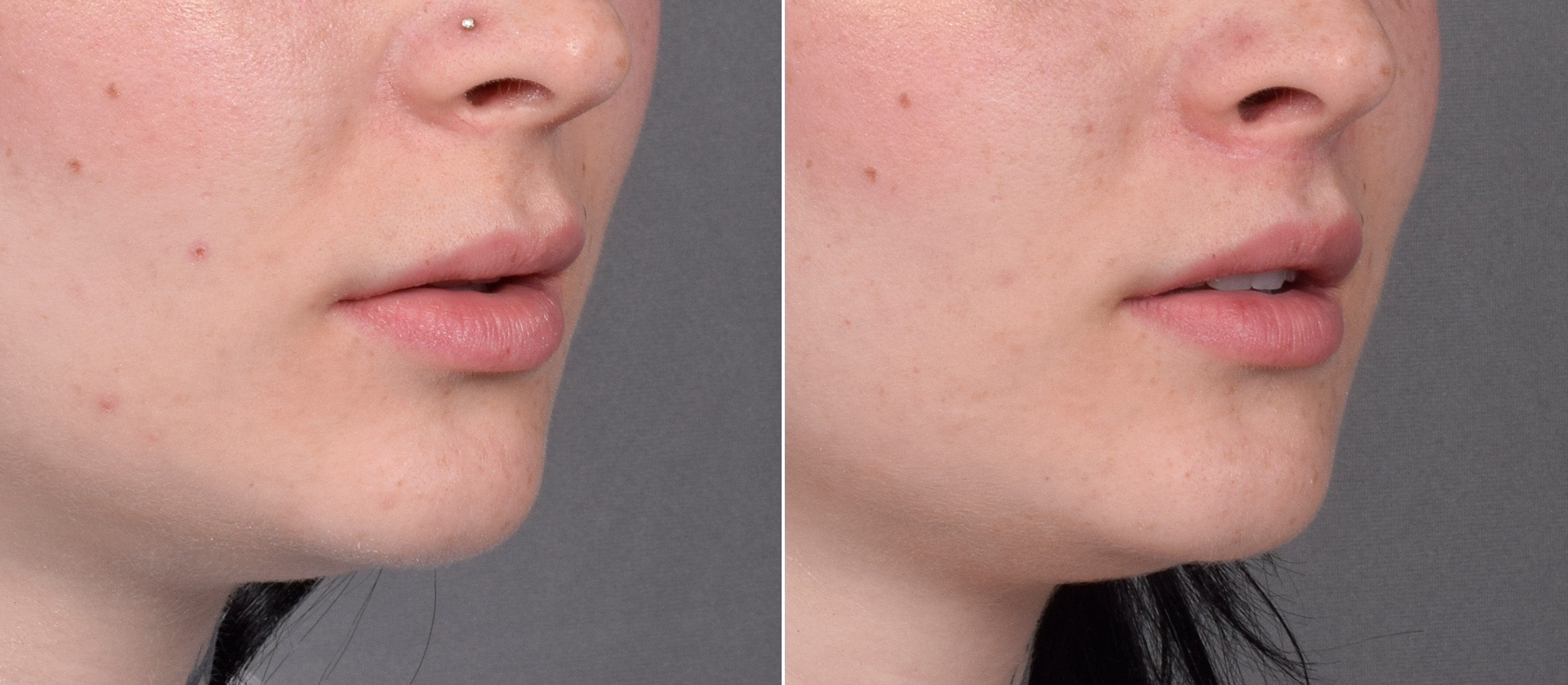 Lip Lift Before & After Gallery - Patient 342755 - Image 2
