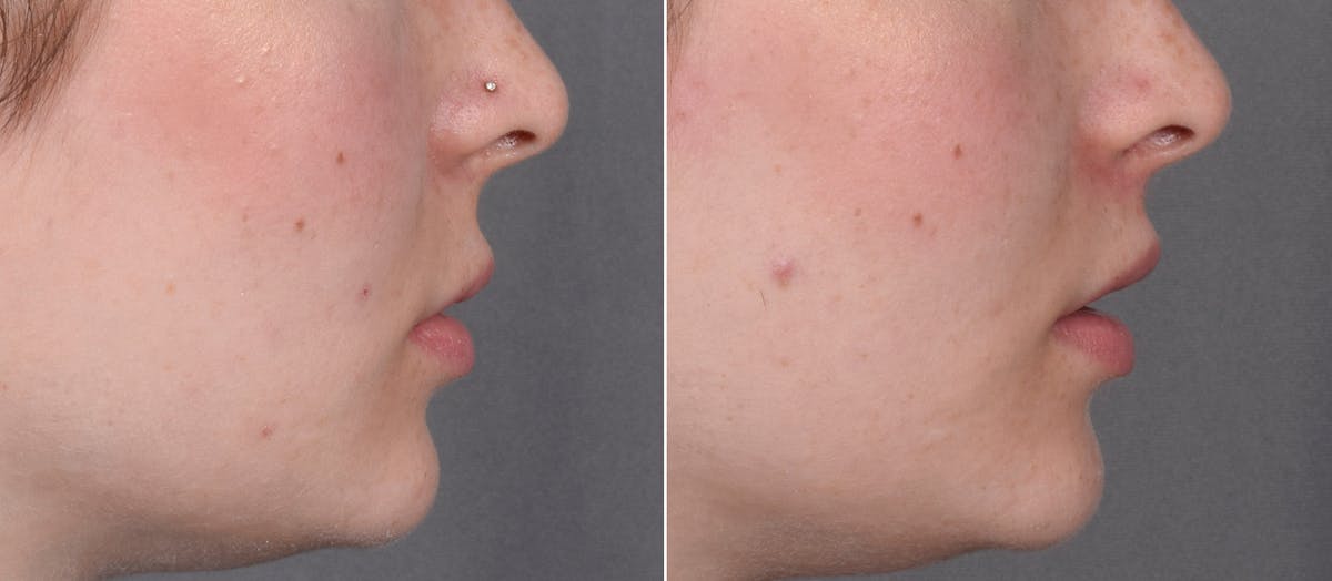 Lip Lift Before & After Gallery - Patient 342755 - Image 4