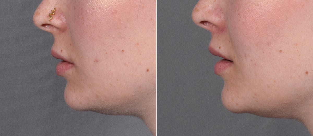 Lip Lift Before & After Gallery - Patient 342755 - Image 6