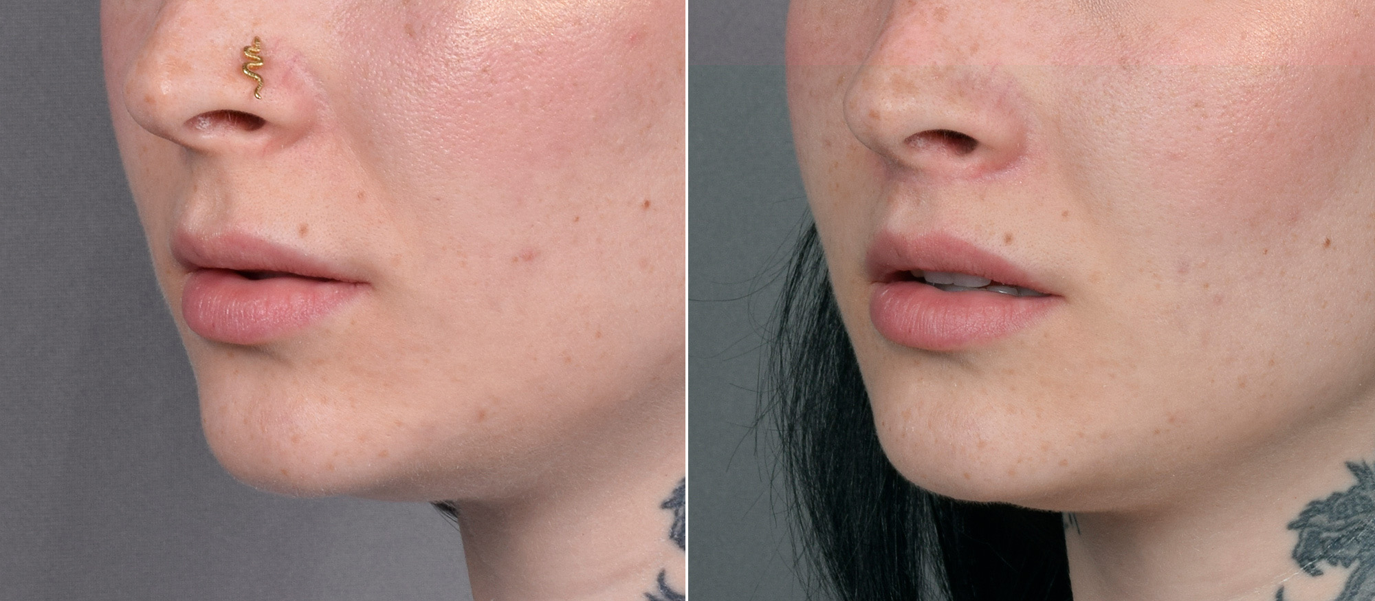 Lip Lift Before & After Gallery - Patient 342755 - Image 3