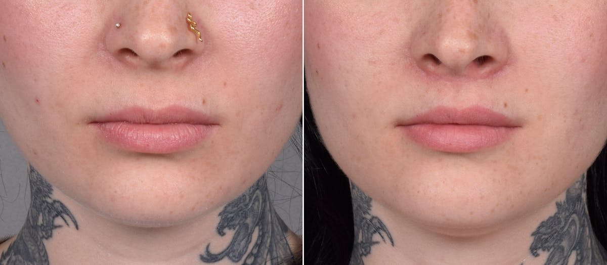 Lip Lift Before & After Gallery - Patient 342755 - Image 5