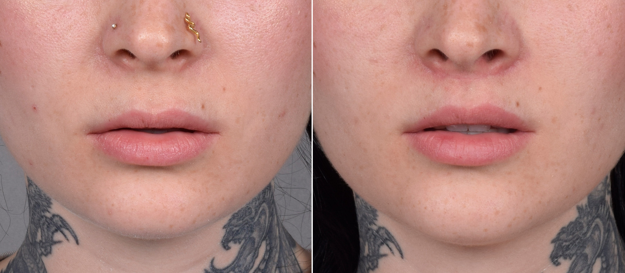 Lip Lift Before & After Gallery - Patient 342755 - Image 1