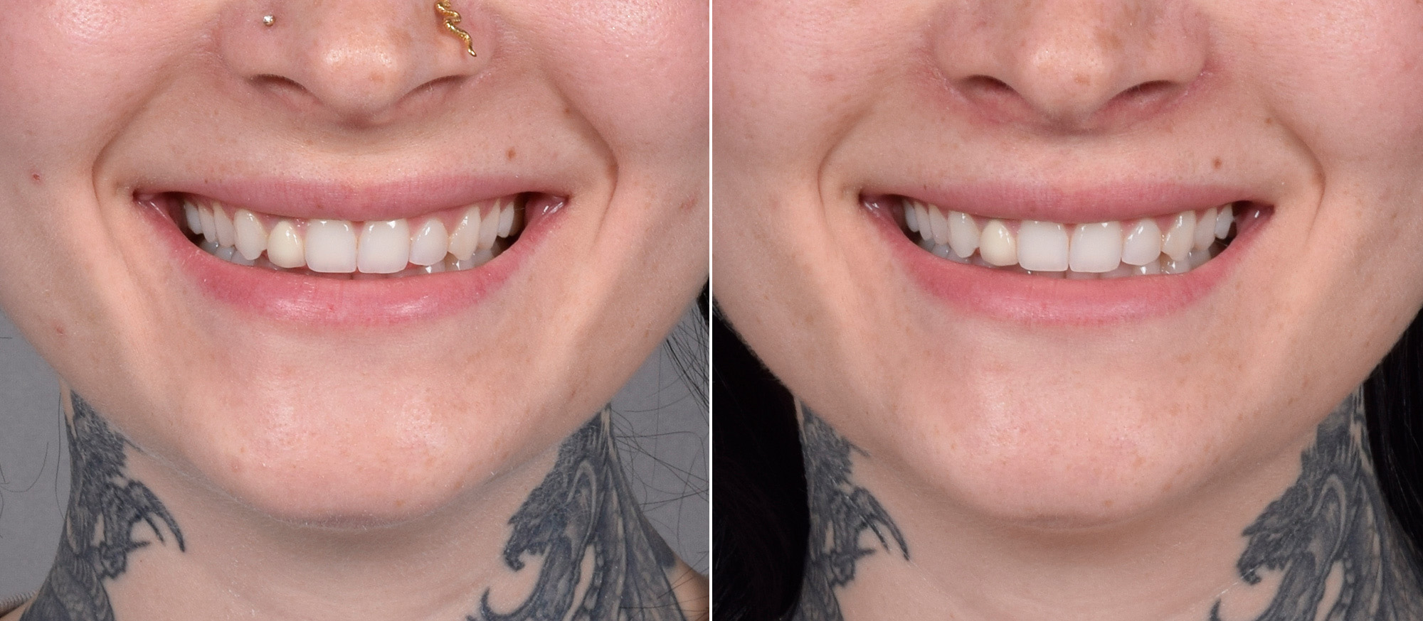 Lip Lift Before & After Gallery - Patient 342755 - Image 7