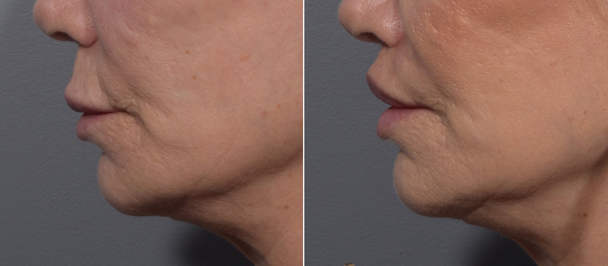 Lip Lift Before & After Gallery - Patient 307414 - Image 2