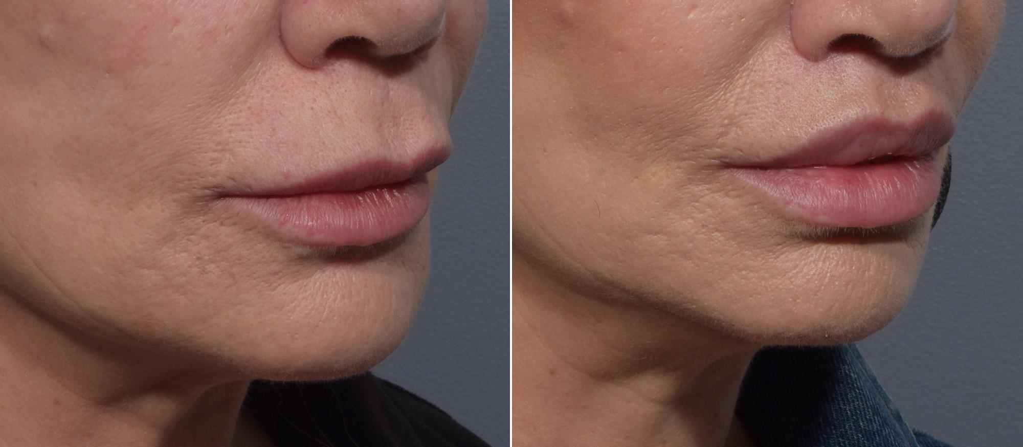 Lip Lift Before & After Gallery - Patient 307414 - Image 4