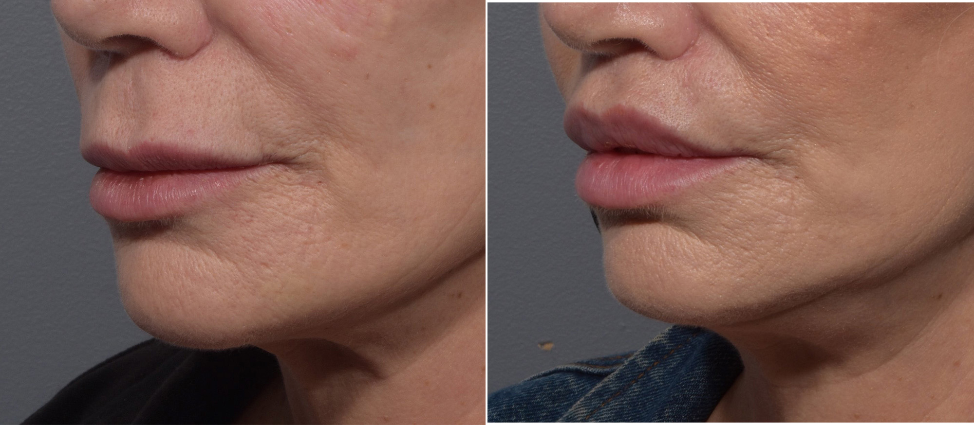 Lip Lift Before & After Gallery - Patient 307414 - Image 5