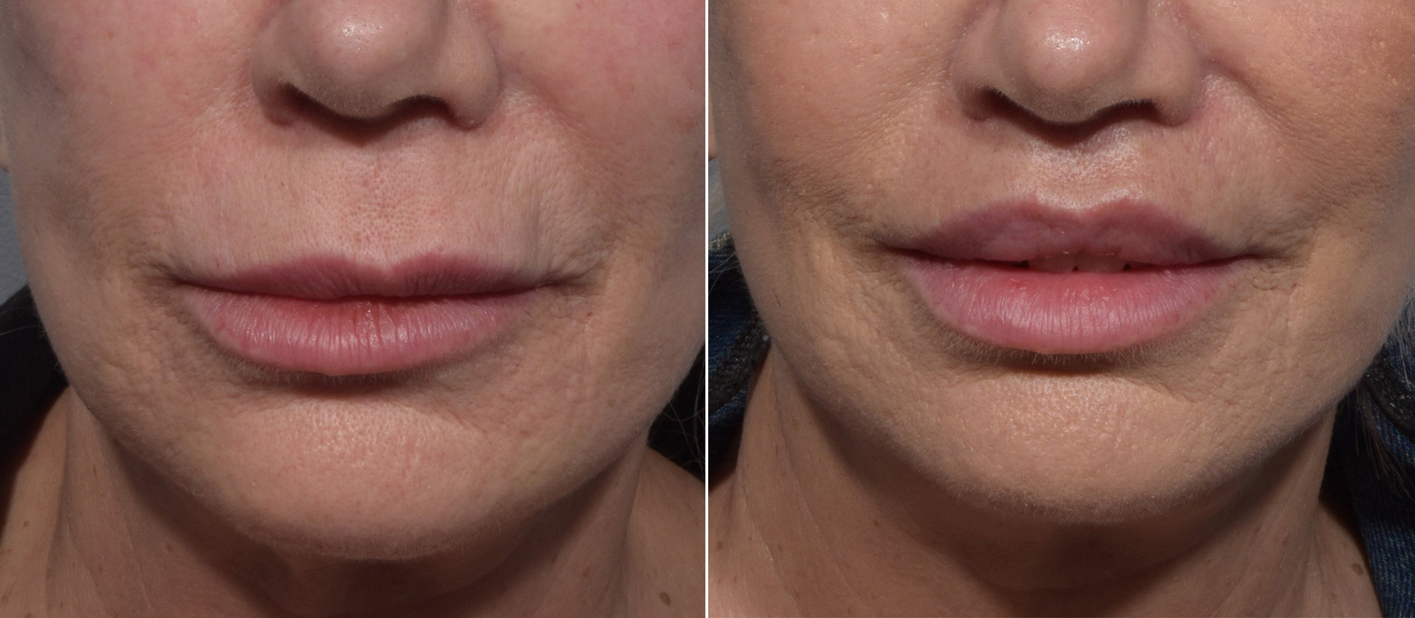 Lip Lift Before & After Gallery - Patient 307414 - Image 1