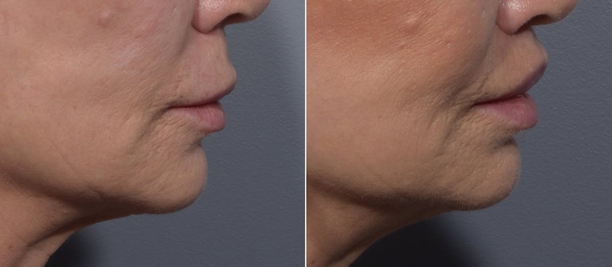 Lip Lift Before & After Gallery - Patient 307414 - Image 3