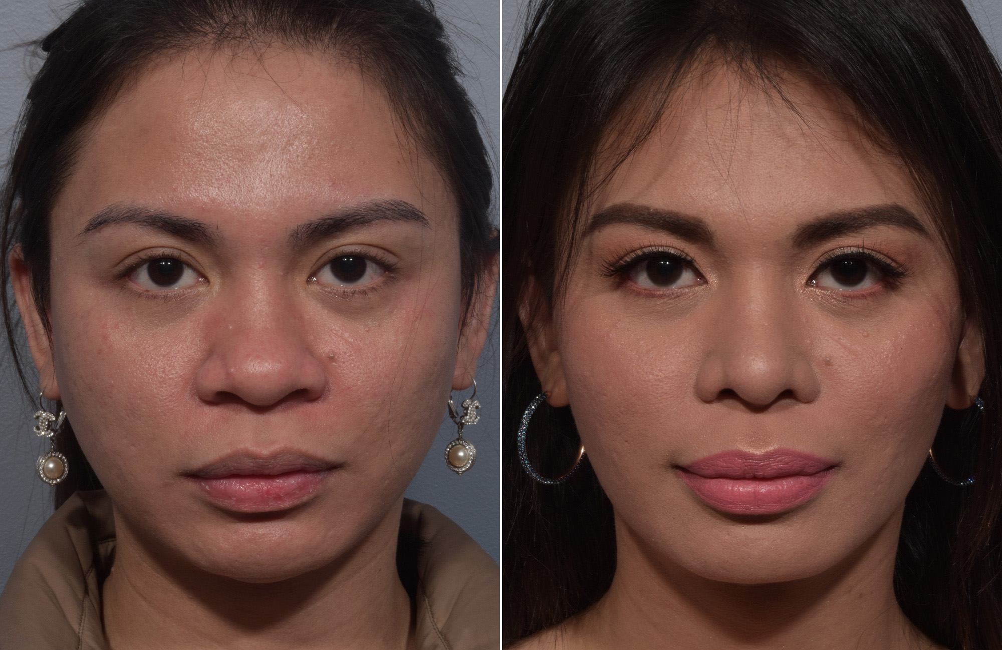 Buccal Fat Removal Before & After Gallery - Patient 578551 - Image 1