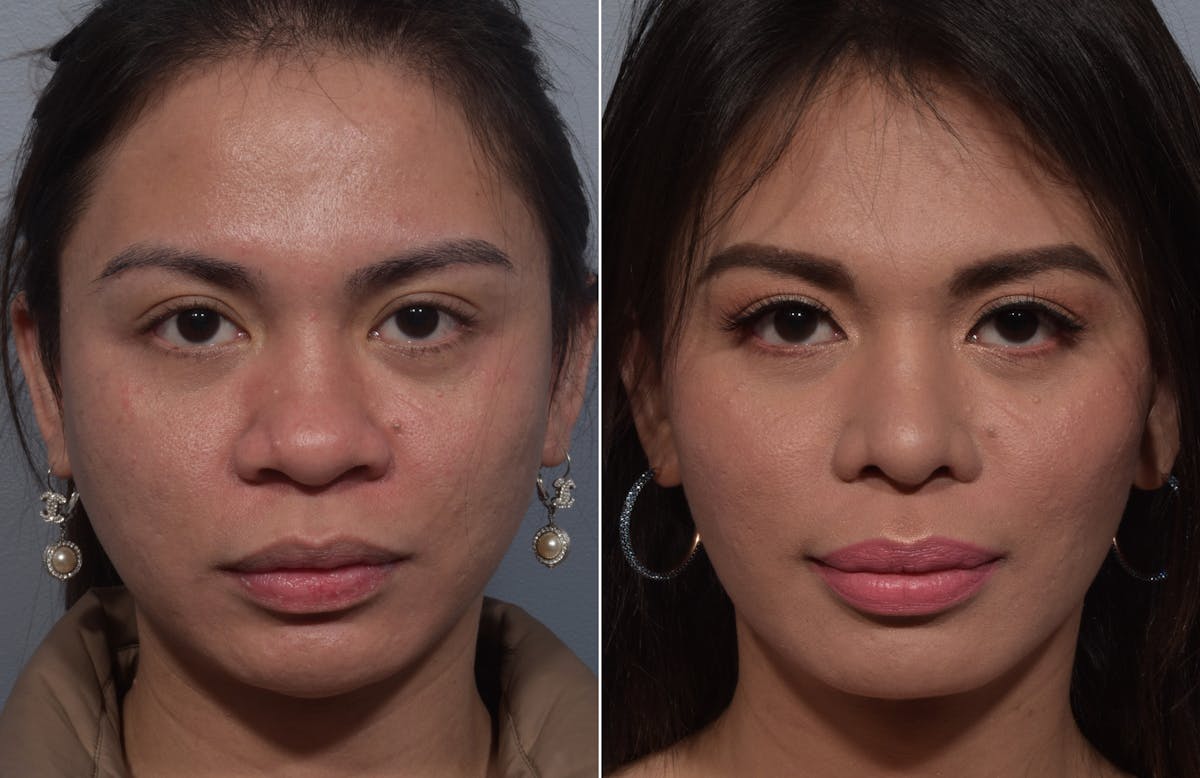 Rhinoplasty Before & After Gallery - Patient 327957 - Image 2