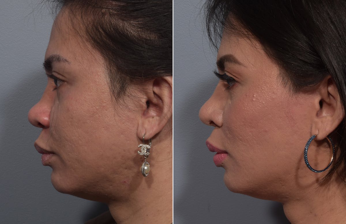 Rhinoplasty Before & After Gallery - Patient 327957 - Image 5