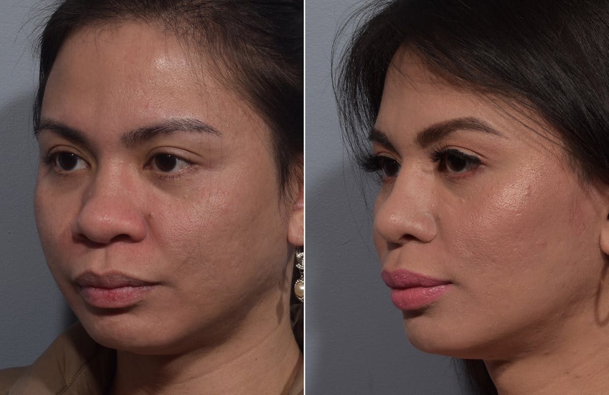 Rhinoplasty Before & After Gallery - Patient 327957 - Image 4