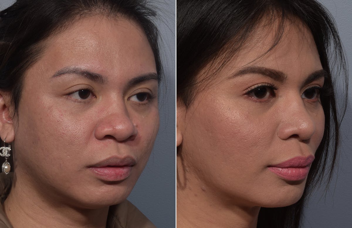 Rhinoplasty Before & After Gallery - Patient 327957 - Image 3