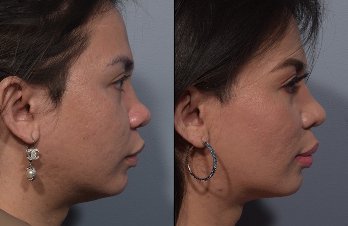 Rhinoplasty Before & After Gallery - Patient 327957 - Image 1