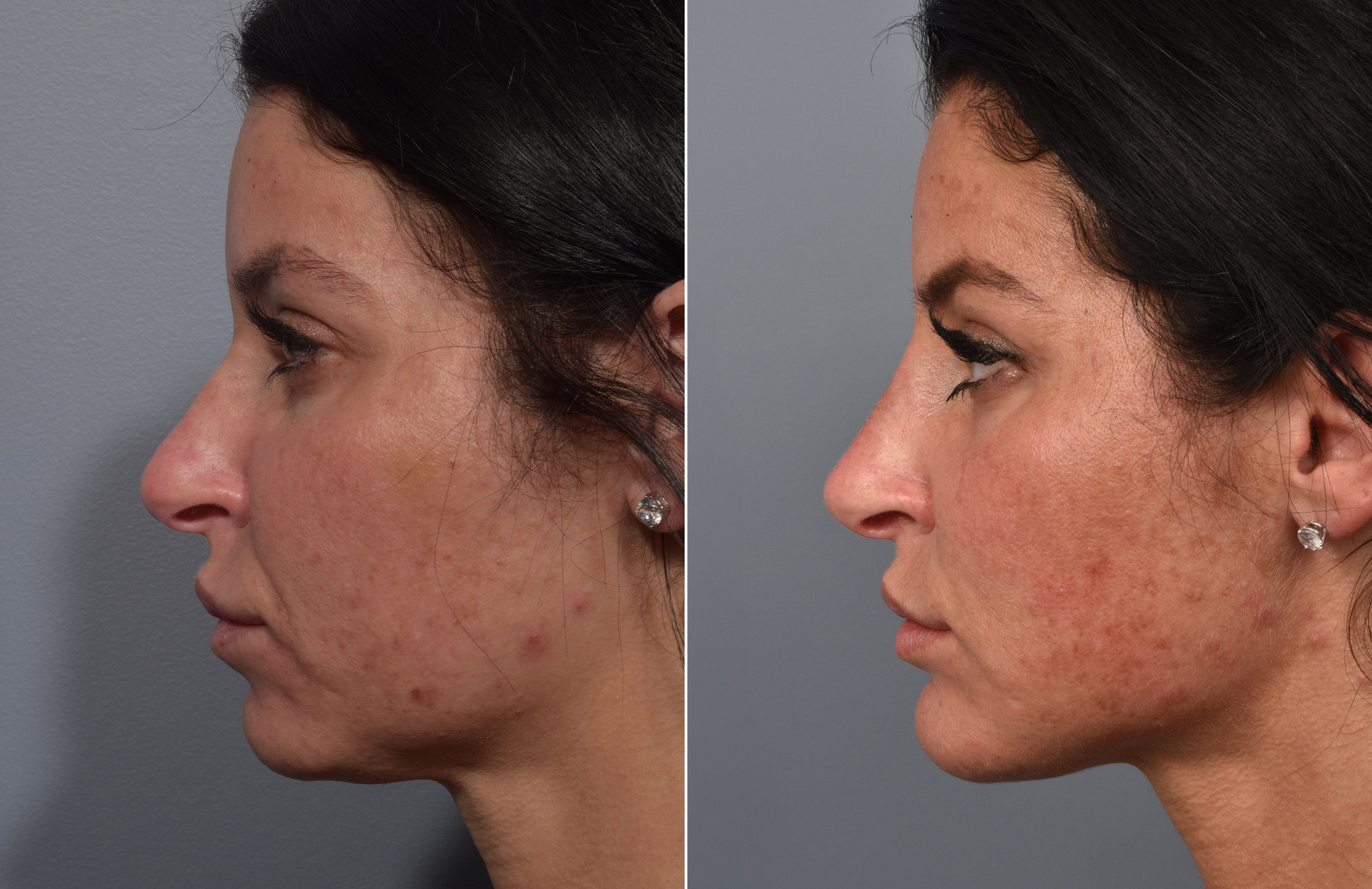 Non-Surgical Rhinoplasty Before & After Gallery - Patient 378980 - Image 1