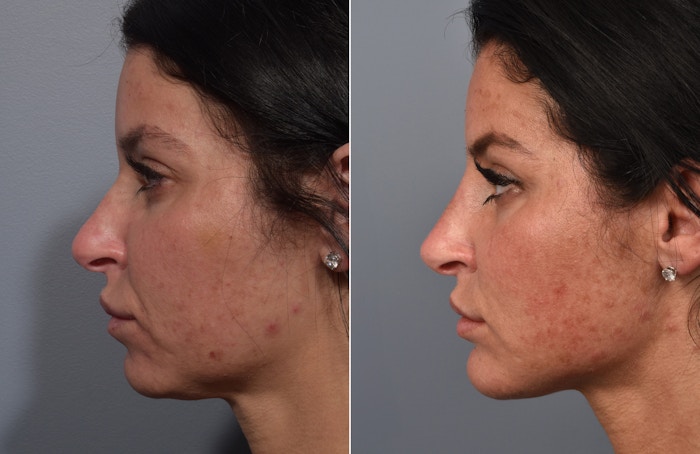 Liposuction Before & After Gallery - Patient 234311 - Image 1