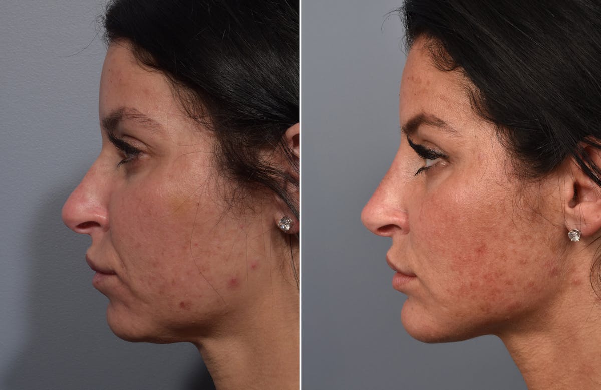 Liposuction Before & After Gallery - Patient 234311 - Image 1