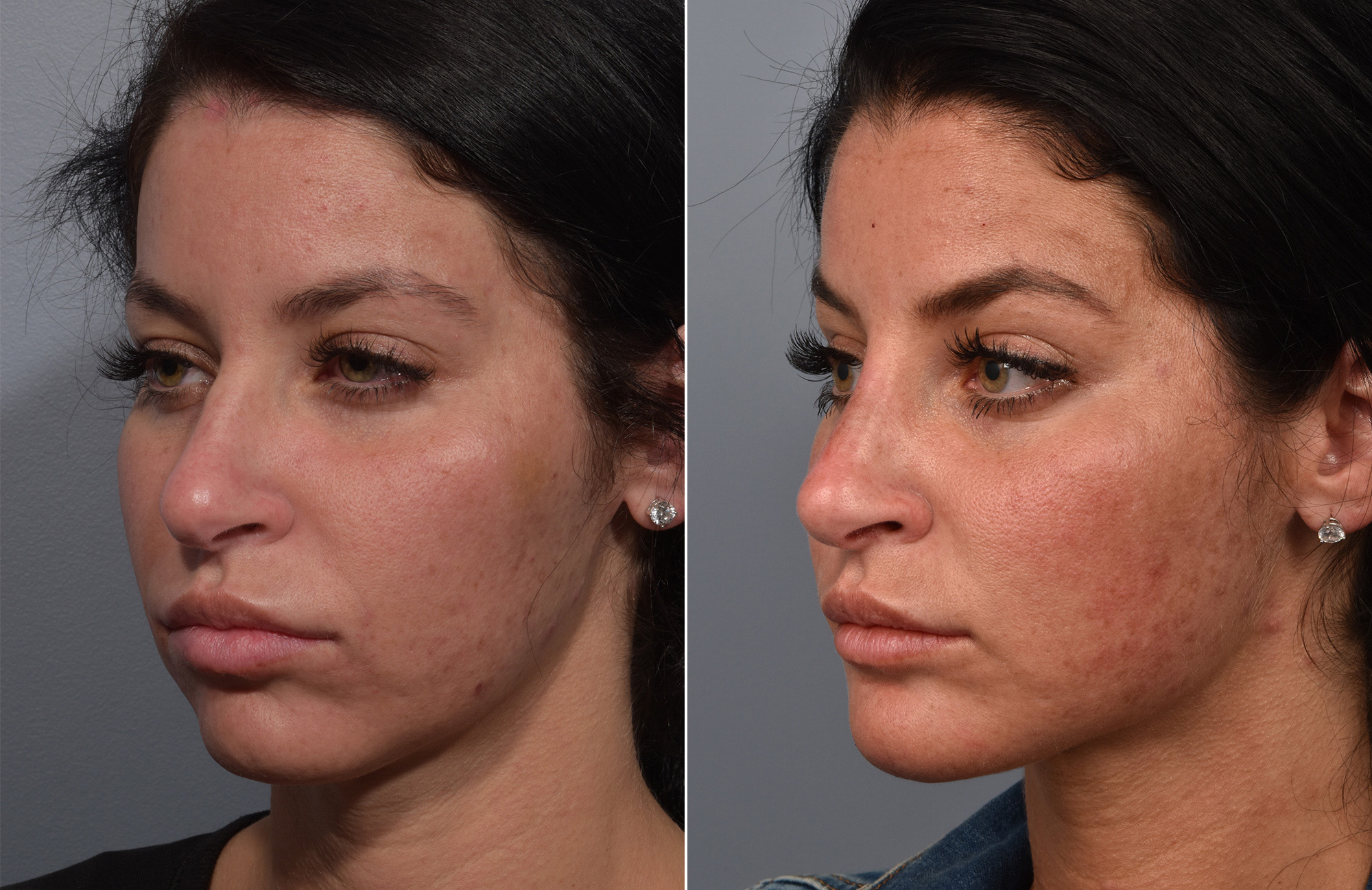 Non-Surgical Rhinoplasty Before & After Gallery - Patient 378980 - Image 2