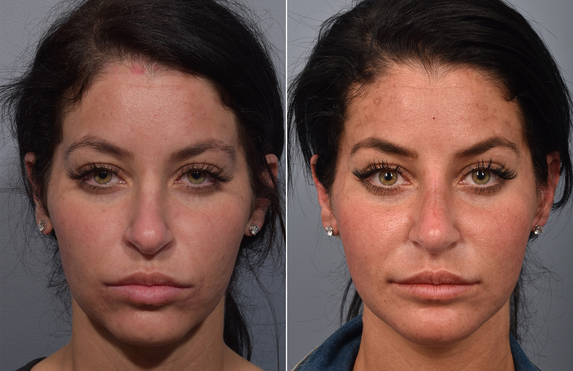 Non-Surgical Rhinoplasty Before & After Gallery - Patient 378980 - Image 5