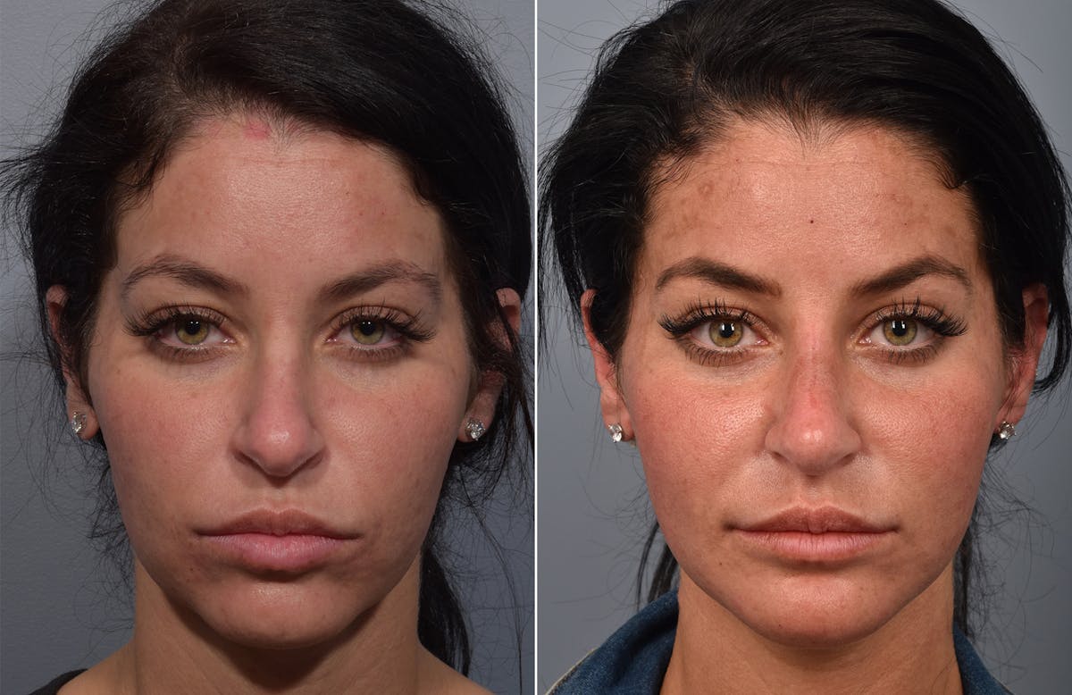 Liposuction Before & After Gallery - Patient 234311 - Image 2