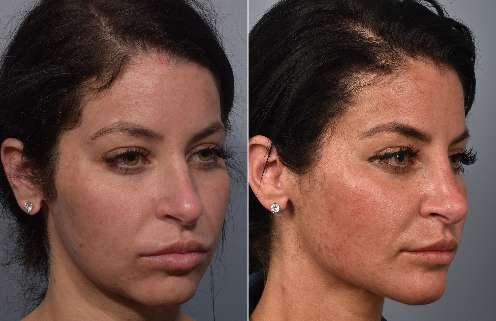 Non-Surgical Rhinoplasty Before & After Gallery - Patient 378980 - Image 3