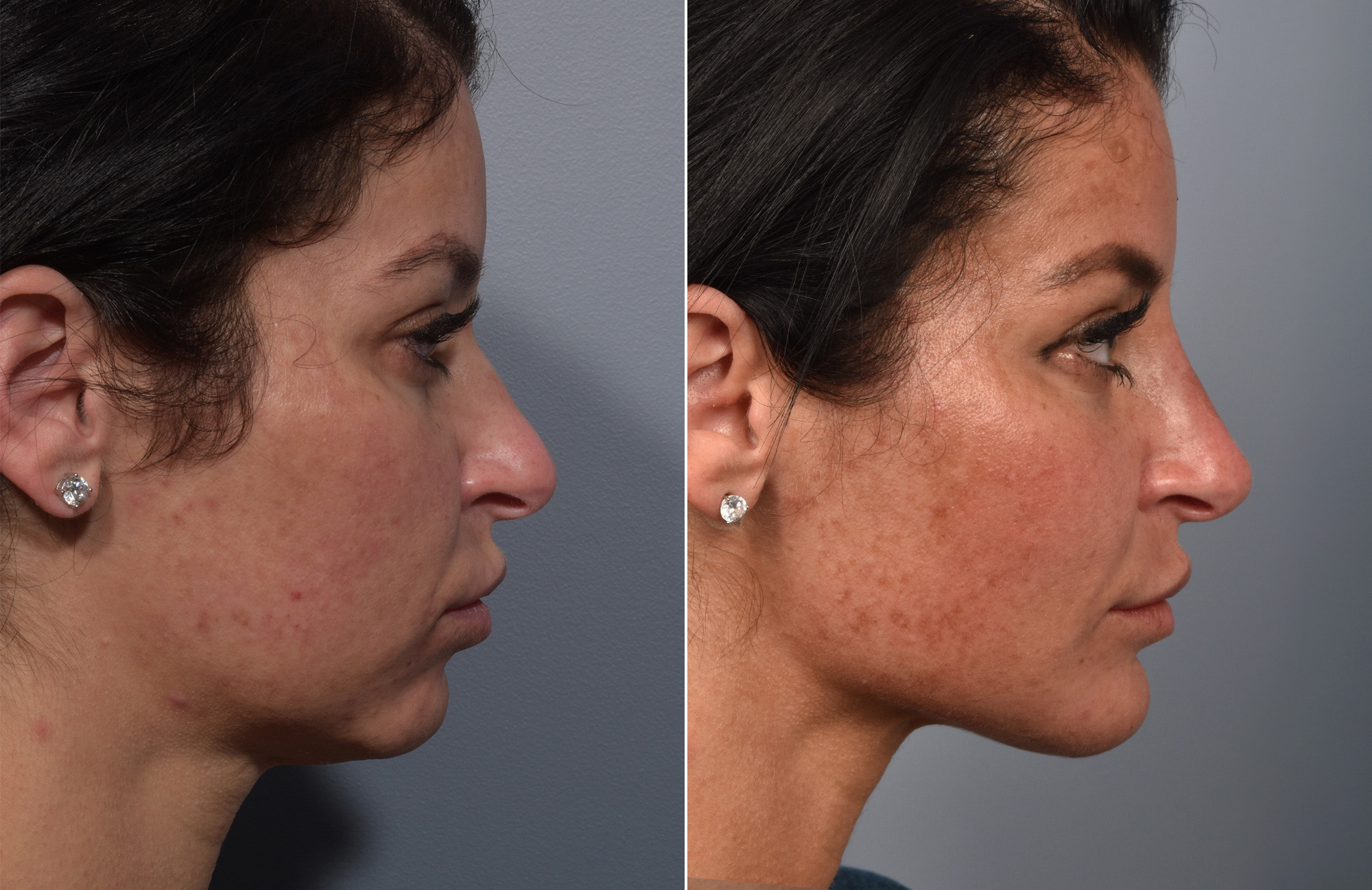 Non-Surgical Rhinoplasty Before & After Gallery - Patient 378980 - Image 4