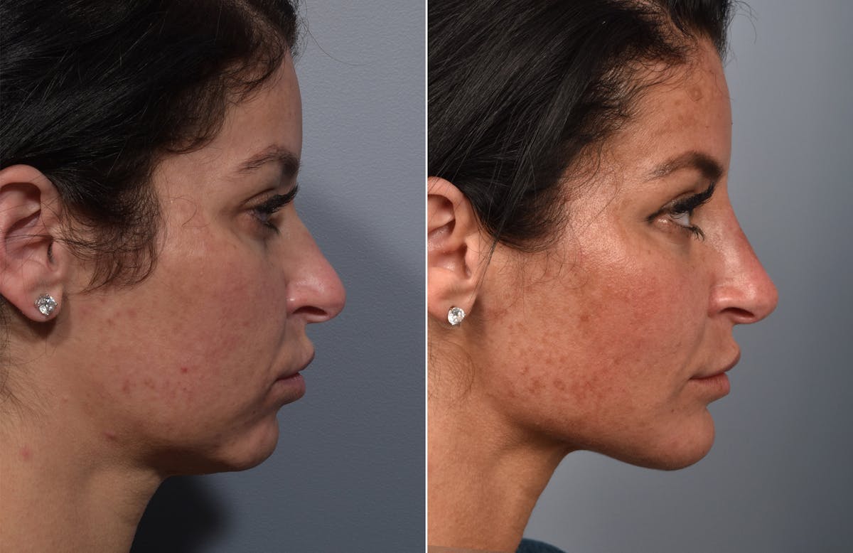 Liposuction Before & After Gallery - Patient 234311 - Image 4